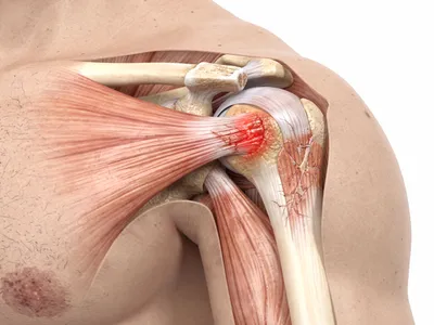 Перенапряжение мышц — лечение